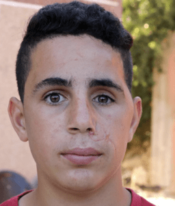 Mohammad Tamimi, after reconstructive surgery in South Africa