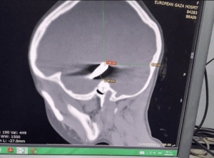 A brain scan shows a bullet lodged in the skull of an eight-year-old Palestinian girl.