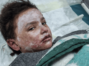 A child recovers at the European hospital near Rafah, Gaza, in February 2024.
