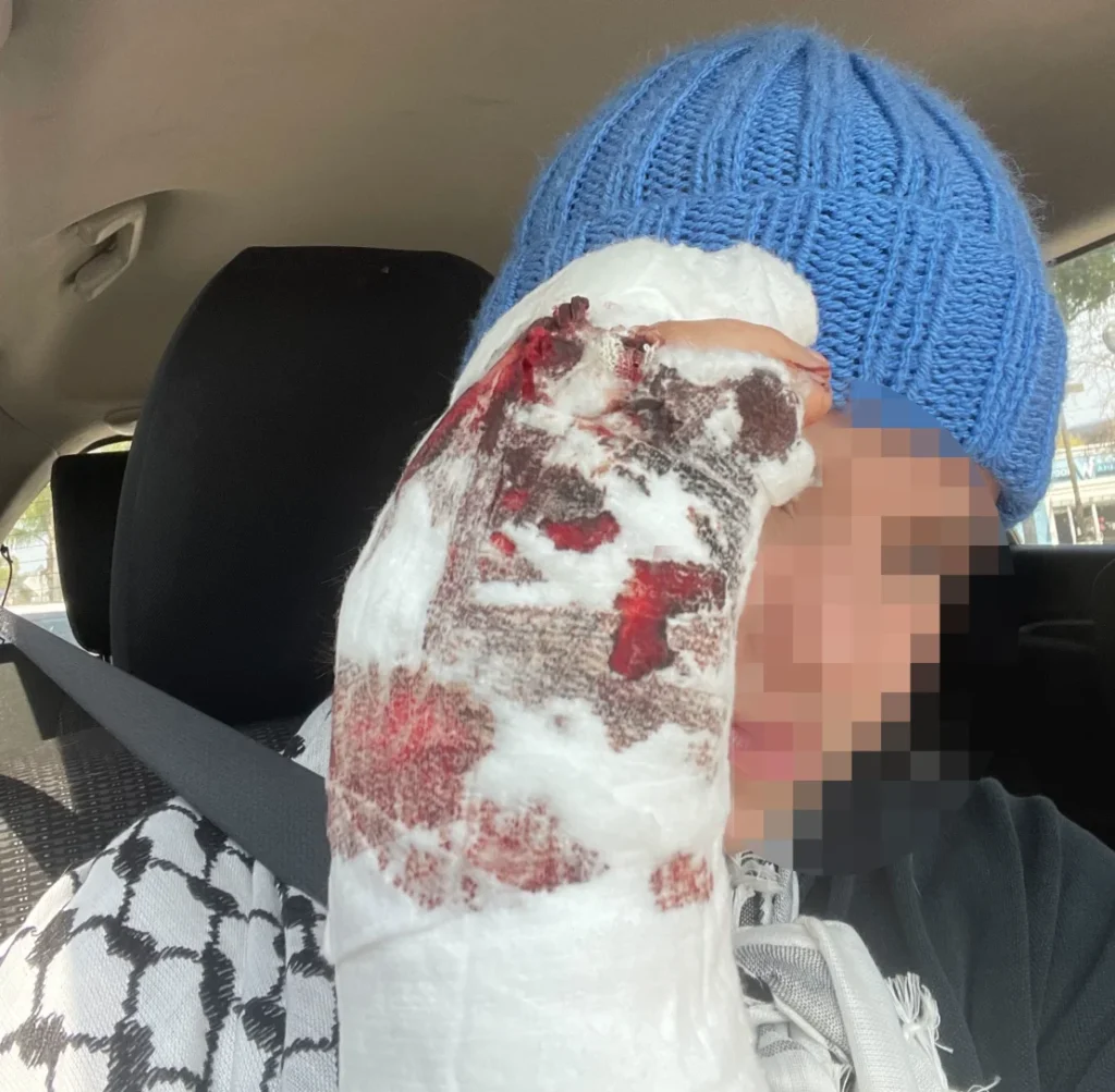 Thistle Boosinger, a 23-year-old member of the encampment, had her hand smashed the night of the violence. Boosinger requested CNN obscure a portion of this image over privacy concerns following recent developments.