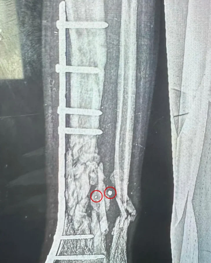 X-ray of the damage done to a 15-year-old’s leg by fragmentation shrapnel, some of which is still lodged in the bone. The surgeon said: “The shrapnel entered from the left into the tibia bone and exited through the fibula to the right of the image. Our word for very smashed bone is ‘comminuted’. Bone comminution does not get greater than this.” The surgeon has put in a stainless steel plate screwed into the tibia.