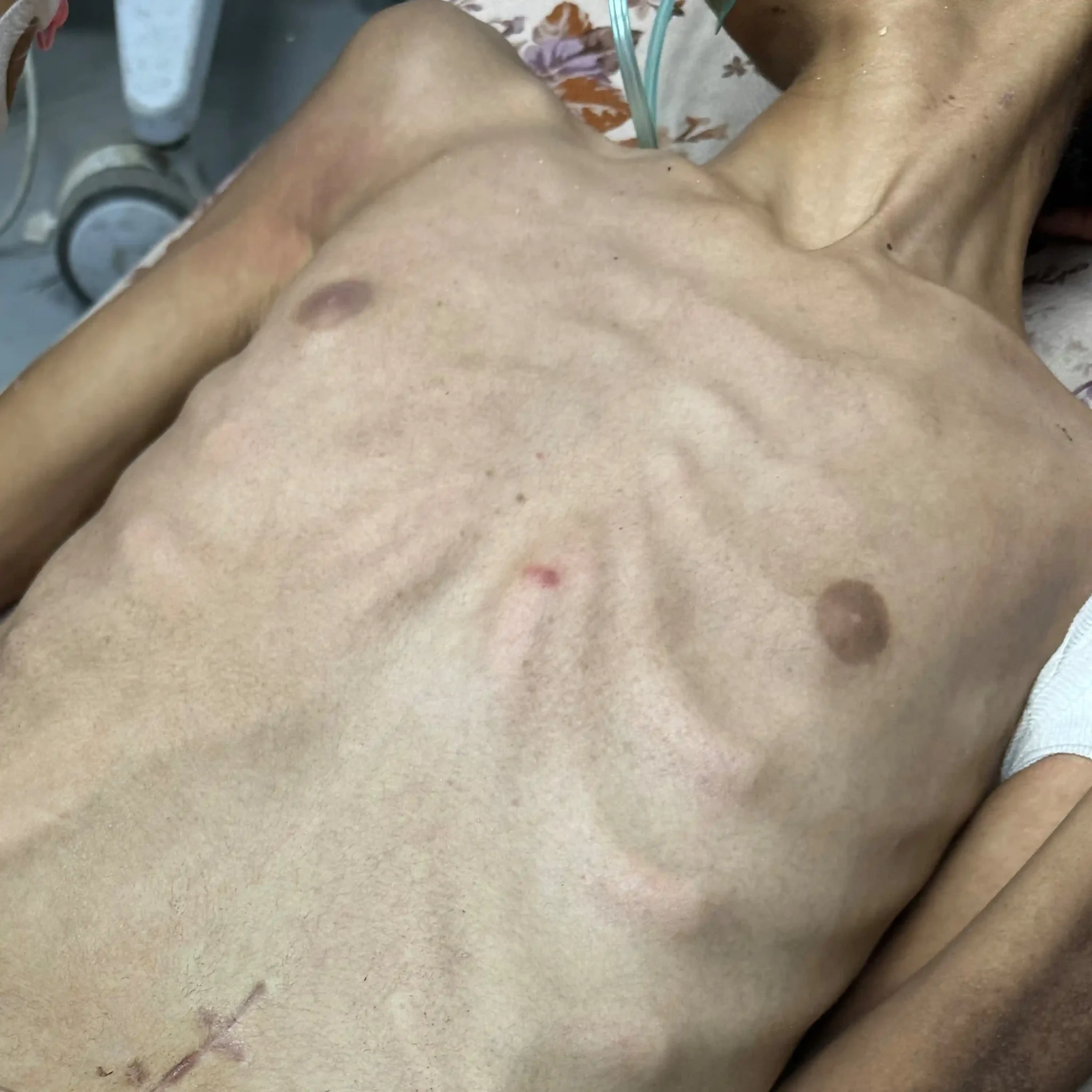 A 15-year-old malnourished boy with a pinhole wound in the middle of his chest. 