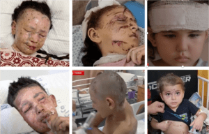 A few of the many children wounded by shrapnel – some also severely burned – in the course of Israel's now nine-month-long attack on Gaza. The weapons create small pieces of shrapnel that leave barely discernible entry wounds but create extensive destruction inside the body.