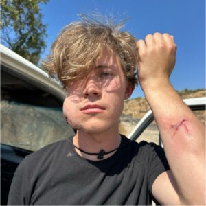 The German Int'l Solidarity Movement volunteer after being attacked by settlers.