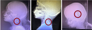 These photographs of X-rays were provided by Dr. Mimi Syed, who worked in Khan Younis from Aug. 8 to Sept. 5. She said: “I had multiple pediatric patients, mostly under the age of 12, who were shot in the head or the left side of the chest. Usually, these were single shots. The patients came in either dead or critical, and died shortly after arriving.”