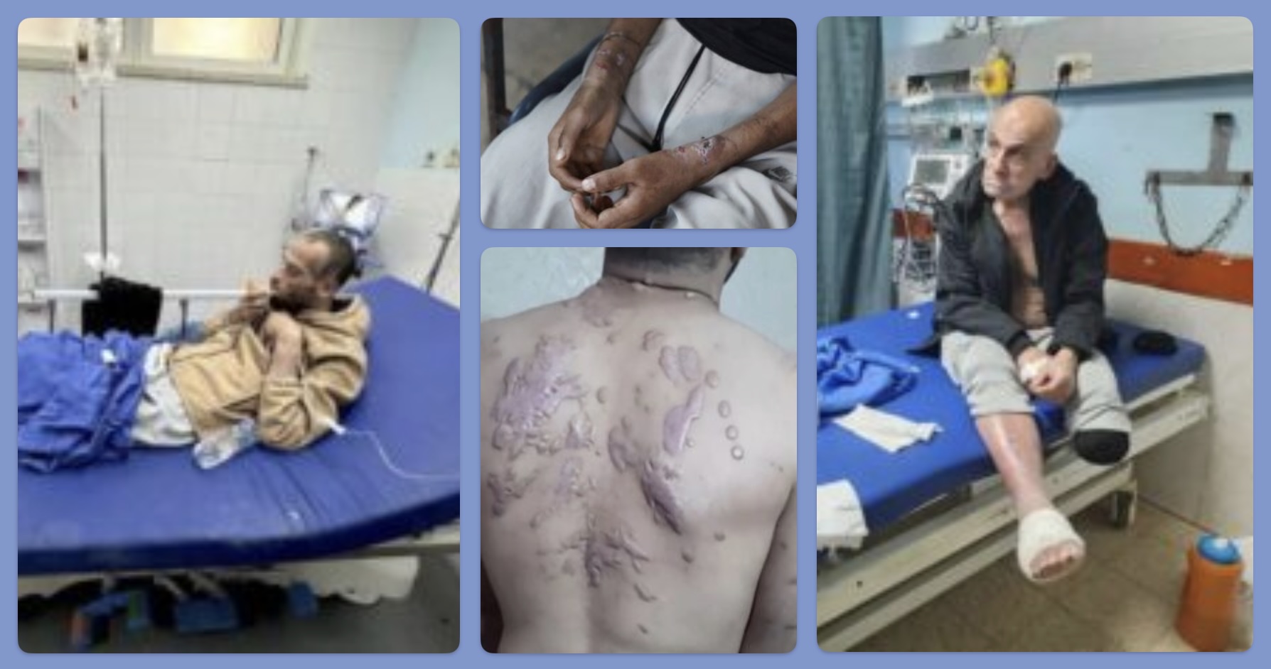 Recently released Palestinian prisoners show signs of malnutrition, medical negligence, and torture. Many reportedly had their legs bound to tightly for so long, that they got gangrene, and were subject to amputations (without anesthesia) while in prison.