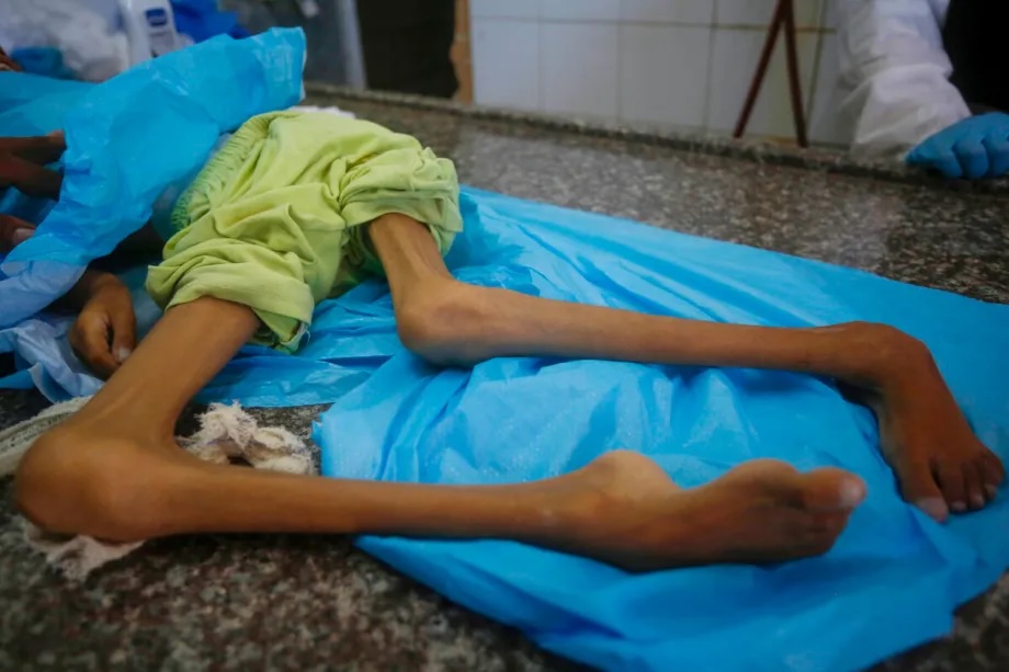 The body of 10-year-old Palestinian girl Amine Maruf, who died from malnutrition in the blockaded Gaza Strip, is brought to Al-Aqsa Martyrs Hospital in Deir al-Balah for funeral procedures on September 12, 2025.