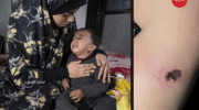 ‘Cigarette Burns, Nail Wounds’: Toddler Tortured in Gaza to Coerce Father