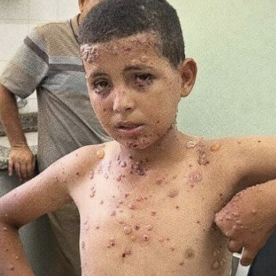 Contagious skin diseases plague thousands of Gazans, in what medical officials describe as a rapidly escalating public‑health emergency.